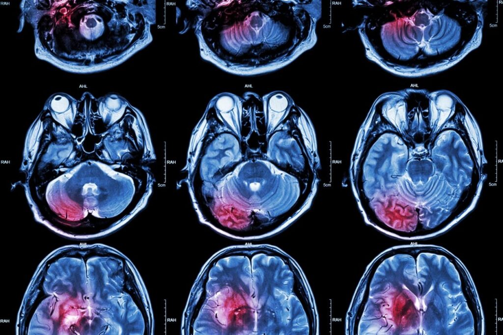Zen Cannabis Clinic MRI images of brain tumors, showcasing various types. Image relates to medical marijuana for Huntington's Disease by Zen Cannabis Clinic.